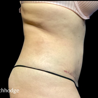 Tummy Tuck Before & After Patient #6268