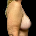 Breast Augmentation Before & After Patient #6269