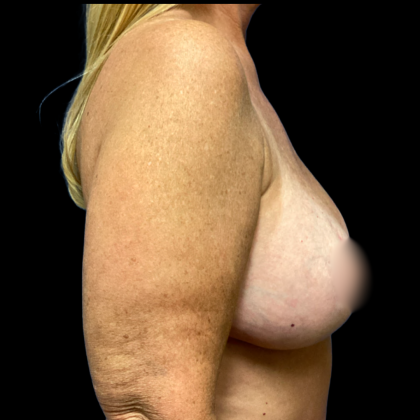 Breast Augmentation Before & After Patient #6269