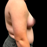 Breast Reduction Before & After Patient #6271