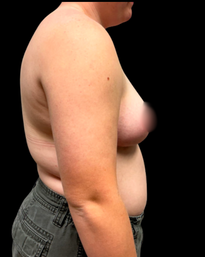 Breast Reduction Before & After Patient #6271
