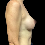 Breast Augmentation Before & After Patient #6272