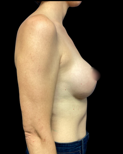 Breast Augmentation Before & After Patient #6272