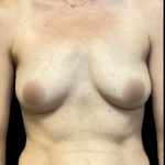Breast Augmentation Before & After Patient #6521