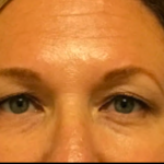 Blepharoplasty Before & After Patient #6479