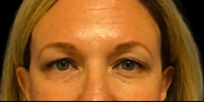 Blepharoplasty Before & After Patient #6479