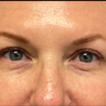 Blepharoplasty Before & After Patient #6479