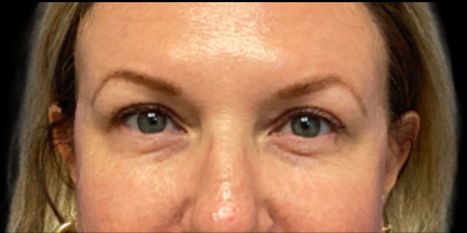 Blepharoplasty Before & After Patient #6479