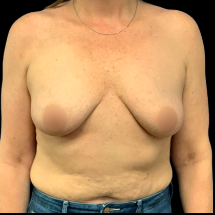 BBA Motiva Before & After Patient #6414