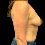 BBA Motiva Before & After Patient #6414