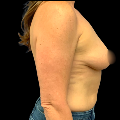 BBA Motiva Before & After Patient #6414