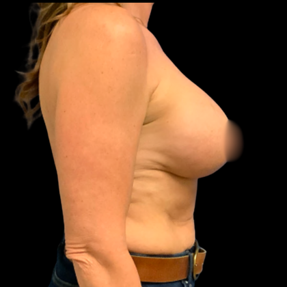 BBA Motiva Before & After Patient #6414