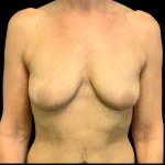 BBA Motiva Before & After Patient #6415
