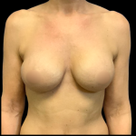 BBA Motiva Before & After Patient #6415