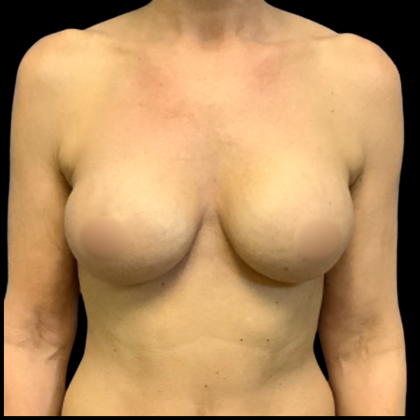 BBA Motiva Before & After Patient #6415