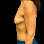 BBA Motiva Before & After Patient #6415