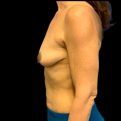BBA Motiva Before & After Patient #6415