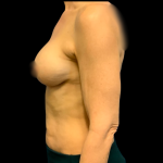 BBA Motiva Before & After Patient #6415