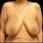 Bilateral Breast Reduction Before & After Patient #6416