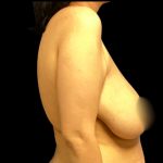 Bilateral Breast Reduction Before & After Patient #6416