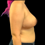 Bilateral Breast Reduction Before & After Patient #6417
