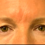 Blepharoplasty Before & After Patient #6418