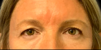 Blepharoplasty Before & After Patient #6418