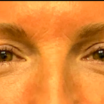 Blepharoplasty Before & After Patient #6418