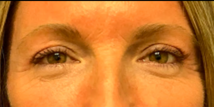 Blepharoplasty Before & After Patient #6418