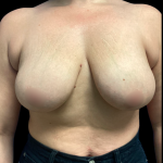 Mastopexy Augmentation Before & After Patient #6390