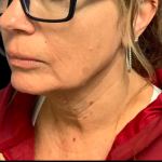 Facelift Before & After Patient #6485