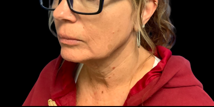 Facelift Before & After Patient #6485