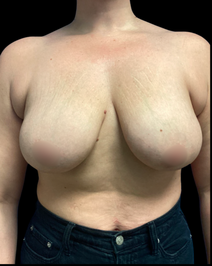 Mastopexy Augmentation Before & After Patient #6390