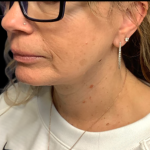 Facelift Before & After Patient #6485