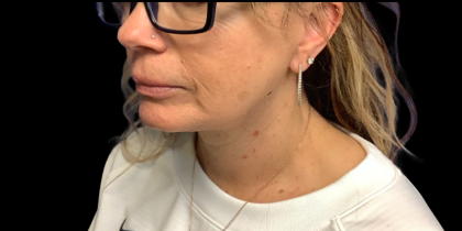Facelift Before & After Patient #6485