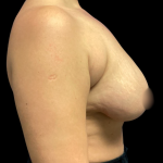 Mastopexy Augmentation Before & After Patient #6390