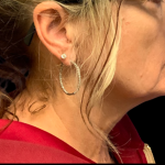 Facelift Before & After Patient #6485