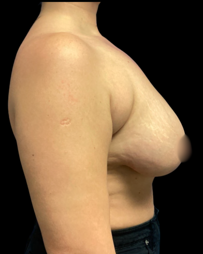 Mastopexy Augmentation Before & After Patient #6390