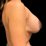 Mastopexy Augmentation Before & After Patient #6390