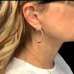 Facelift Before & After Patient #6485