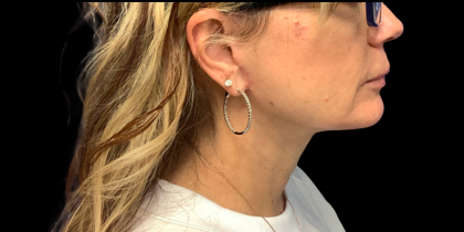 Facelift Before & After Patient #6485