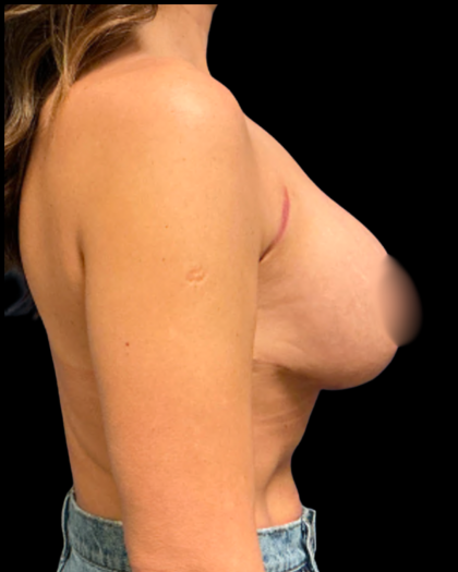 Mastopexy Augmentation Before & After Patient #6390