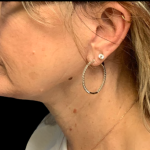 Facelift Before & After Patient #6485