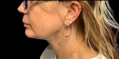 Facelift Before & After Patient #6485