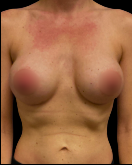 Breast Augmentation Before & After Patient #6521
