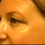 Blepharoplasty Before & After Patient #6479