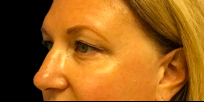 Blepharoplasty Before & After Patient #6479