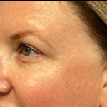 Blepharoplasty Before & After Patient #6479