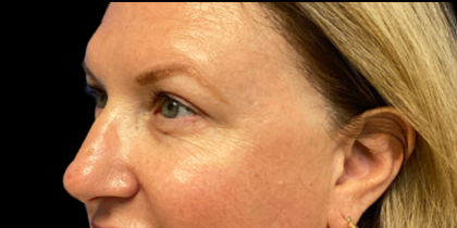 Blepharoplasty Before & After Patient #6479