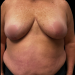 Breast Reduction Before & After Patient #6391